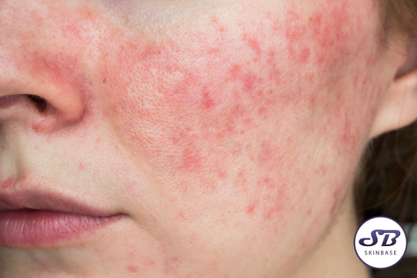 Treating Skin Concerns: IPL for Acne