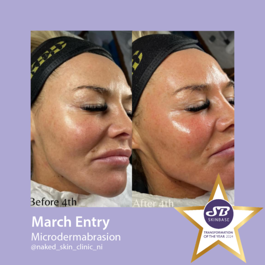 march microdermabrasion naked skin clinic