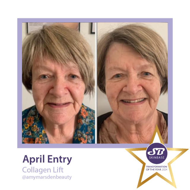 April entries - Amy Marsden - before and after collagen lift