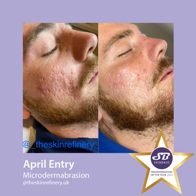 April entries - the skin refinery before and after microdermabrasion